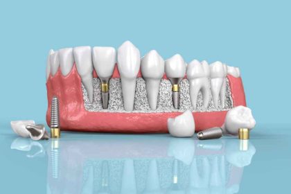 Estimating and Planning for the Price of Dental Implants