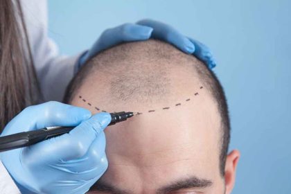 Understanding Hair Transplant Clinics From Consultation to Aftercare