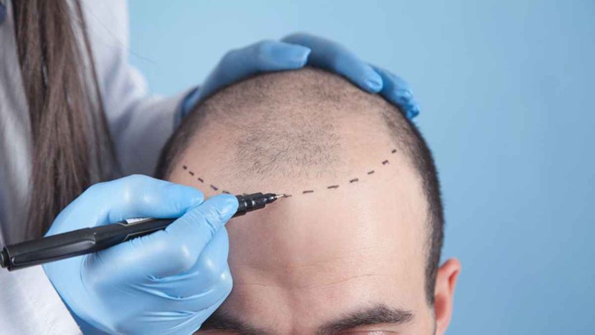 Understanding Hair Transplant Clinics From Consultation to Aftercare