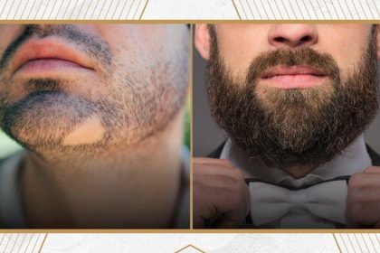 How to Prepare for Beard Hair Transplant Avoid These Common Mistakes.