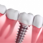 How Much Dental Implants and Other Dental Fixes Can Cost