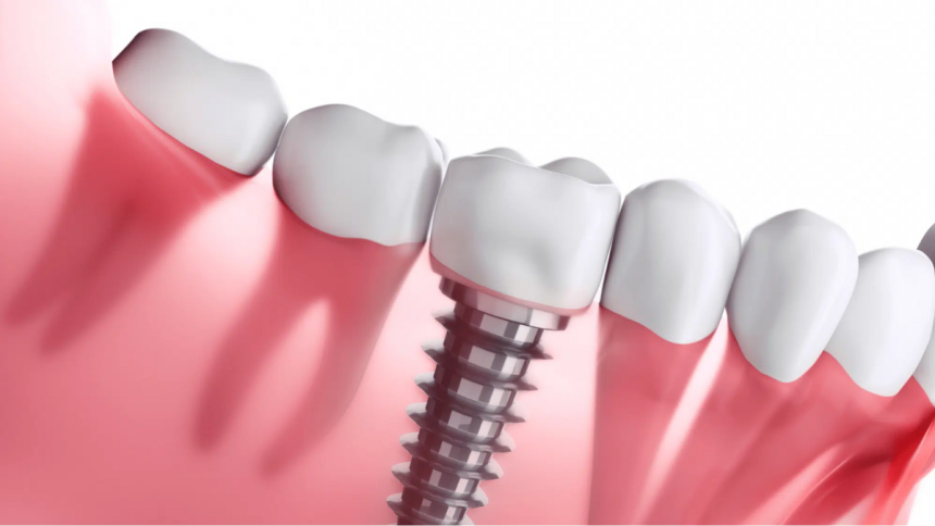 How Much Dental Implants and Other Dental Fixes Can Cost
