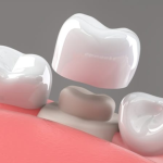 Teeth Cap Cost in India – Getting the Ultimate Deal for Lasting Smiles