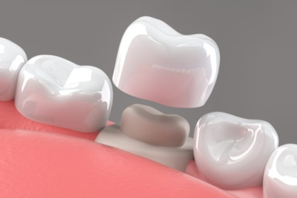 Teeth Cap Cost in India – Getting the Ultimate Deal for Lasting Smiles