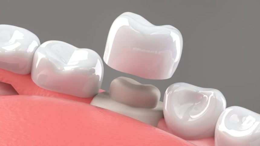 Teeth Cap Cost in India – Getting the Ultimate Deal for Lasting Smiles