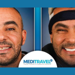 The Rise of Polish Medical Tourism to Turkey Hollywood Smiles and Hair Transplants Redefined