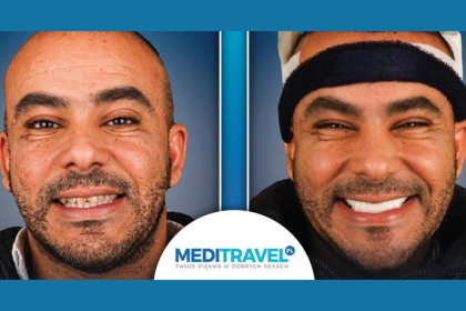 The Rise of Polish Medical Tourism to Turkey Hollywood Smiles and Hair Transplants Redefined
