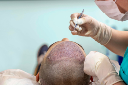 The Science of Afro Hair Follicles Why Technique Matters in Transplants