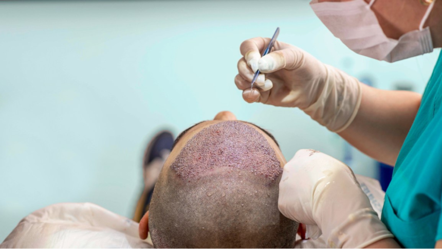 The Science of Afro Hair Follicles Why Technique Matters in Transplants
