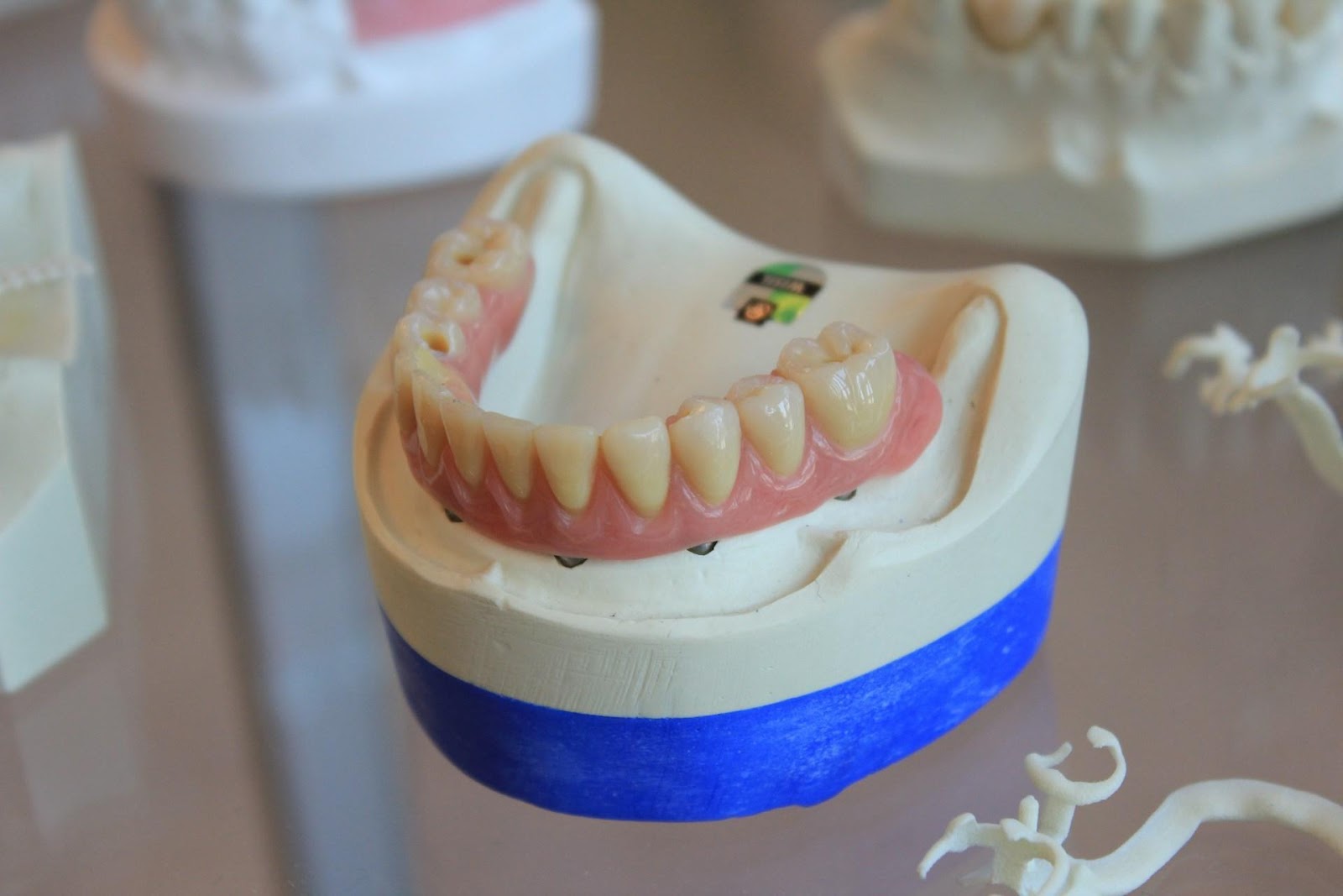 Flexible partial dentures, comfort