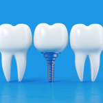 Essential Guide to Dental Implant Maintenance 10 Expert Strategies for Long-lasting Results