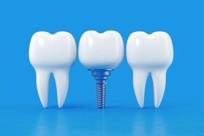 Essential Guide to Dental Implant Maintenance 10 Expert Strategies for Long-lasting Results