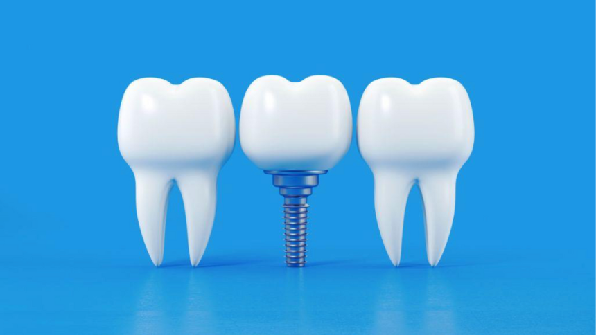 Essential Guide to Dental Implant Maintenance 10 Expert Strategies for Long-lasting Results