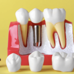 Crowns Vs Implants Everything You Need To Know