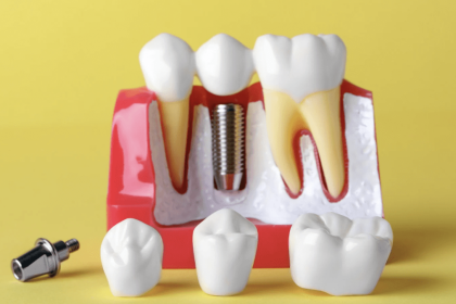 Crowns Vs Implants Everything You Need To Know