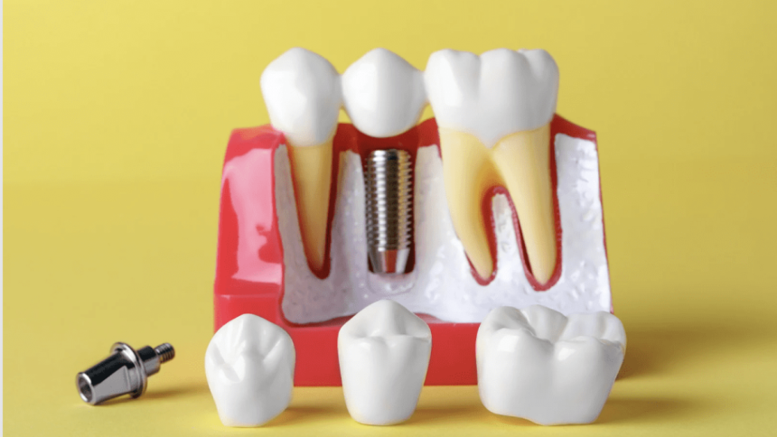 Crowns Vs Implants Everything You Need To Know