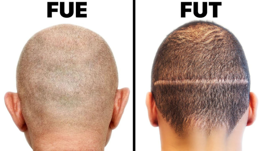 Hair Transplantation Clinic Understanding the Difference Between FUE and FUT
