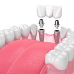 Master Implant Placement and Restoration in One Comprehensive Course
