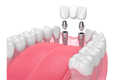 Master Implant Placement and Restoration in One Comprehensive Course