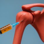 PRP therapy injection for shoulder recovery at a medical clinic in San Diego