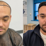 Image 1 of Top Rated Hair Transplant Clinics in Turkey That Specialize in Restoring Receding Hairlines Naturally