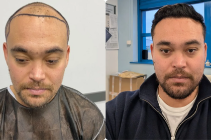 Image 1 of Top Rated Hair Transplant Clinics in Turkey That Specialize in Restoring Receding Hairlines Naturally