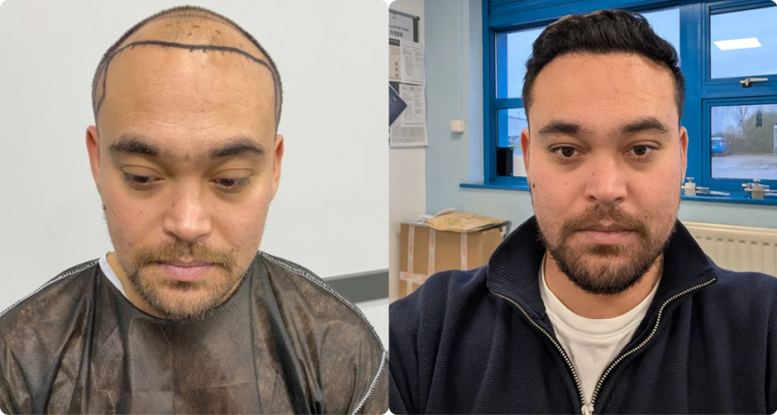 Image 1 of Top Rated Hair Transplant Clinics in Turkey That Specialize in Restoring Receding Hairlines Naturally