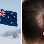 Dry, irritated scalp with visible bumps in winter, highlighting causes of folliculitis in Australia