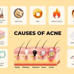 Image 1 of Why The Best Acne Treatment For Adults Must Prioritize Skin Barrier Health And Hydration