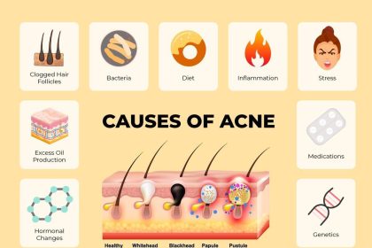 Image 1 of Why The Best Acne Treatment For Adults Must Prioritize Skin Barrier Health And Hydration