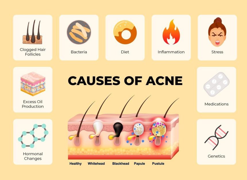 Image 1 of Why The Best Acne Treatment For Adults Must Prioritize Skin Barrier Health And Hydration