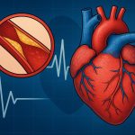 Heart illustration showing blocked coronary arteries linked to ischemic heart disease prevention