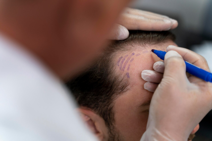 Image 1 of Why FUE Leads The Way In Hair Restoration